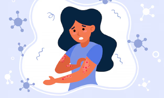 Measles Outbreak in Gauteng: What to do